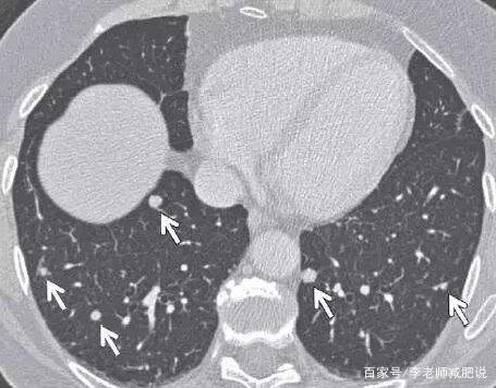 肺上有小结节是怎么回事